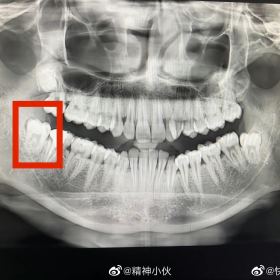 谁说智齿没用的，它可